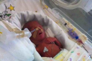 Migliaia di euro raccolti su GoFundMe in poco più di 24 ore per le spese mediche di un bambino nato prematuro
